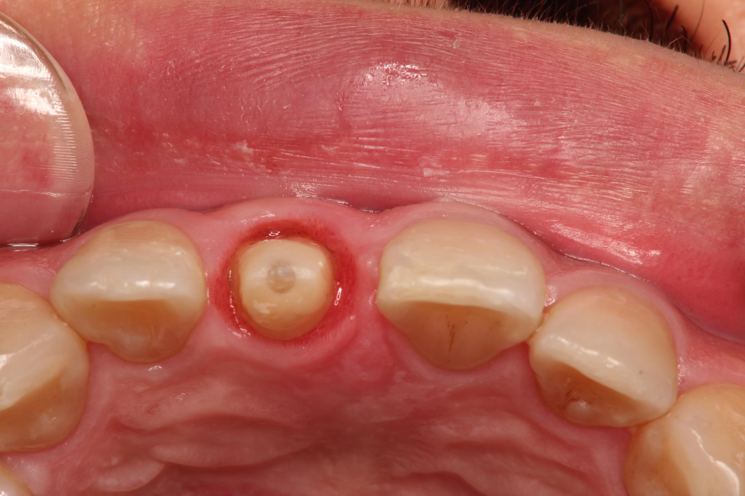 歯を残す治療　Part 3
