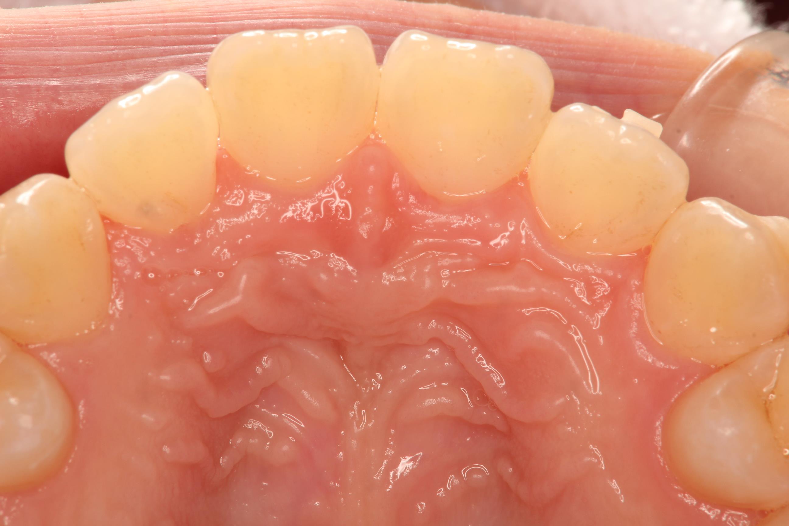 歯のステイン除去３